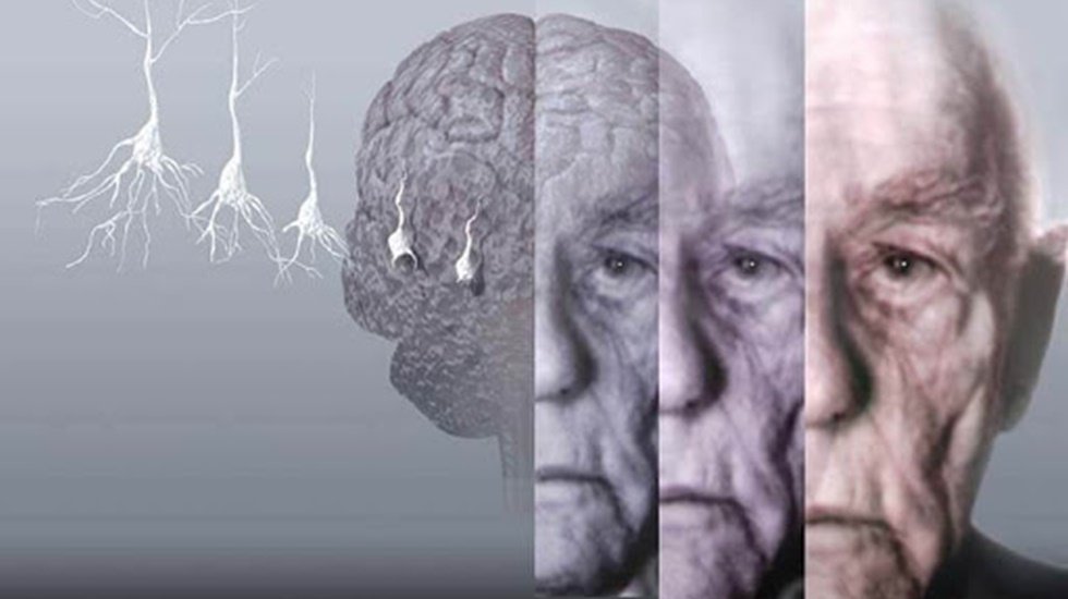 Demansın tedavisinde umut ışığı s&uuml;per yaşlılar&hellip;