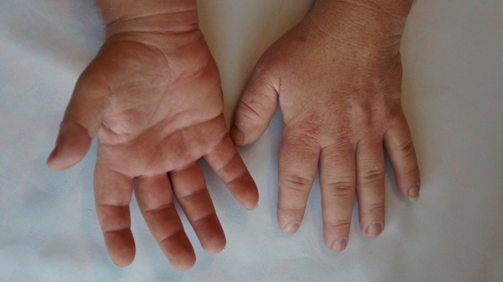 Akromegali hastalığı ge&ccedil; fark edildiği i&ccedil;in tanısı 5-10 yıl gecikiyor!